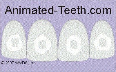 White spot lesions that have formed during orthodontic treatment.
