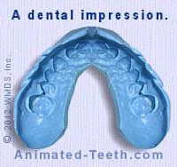 A dental impression is used to make a custom bleaching tray.
