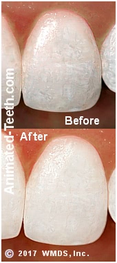 Results of whitening treatments used to treat fluorosis.