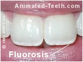 Teeth showing bands of fluorosis stains.