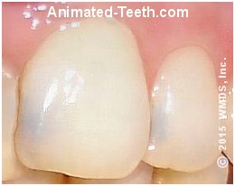 Tooth discoloration caused by tooth decay.