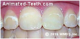 White spot lesions resulting from dental braces.