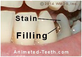 Picture of tooth staining caused by a dental amalgam filling.