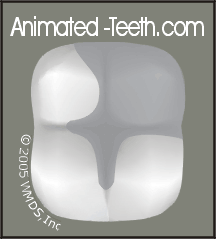 Animation showing illustrations of large composite and amalgam fillings.