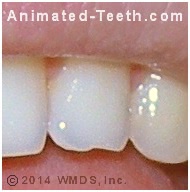 Picture of chipped tooth that could be repaired using dental composite.