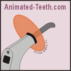 Animation of a dental composite curing light.