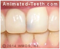 Picture of a front tooth with a cavity that could be repaired using dental composite.