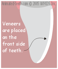 Veneers are placed on the front side of teeth.