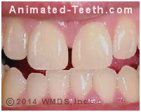 Picture of a gap between two front teeth that could be filled in using dental composite.