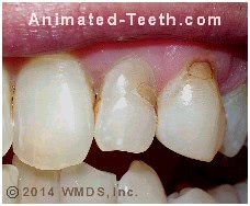 Picture of stained white fillings.
