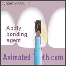 Animation showing placing bonding agent on the etched tooth surface and curing it.