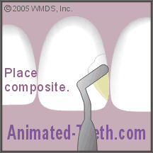 Animation showing placing dental composite on a tooth and curing it.
