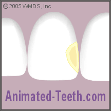 Animation showing acid etching the tooth's enamel in preparation for placing bonding.