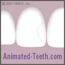 Animation showing shaping and polishing a dental composite restoration.
