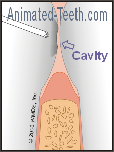 Illustration showing how the sharp edges of a cavity can shred or break dental floss.