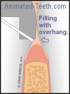 Illustration showing how a dental filling with an overhang will interfere with flossing..