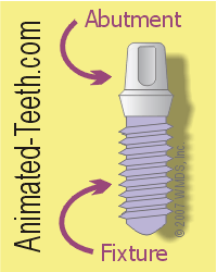 Illustration of the fixture and abutment portions of a dental implant.