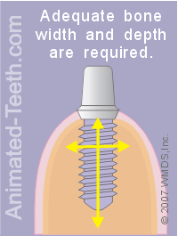Graphic stating that a dental implant requires an adequate amount of bone.