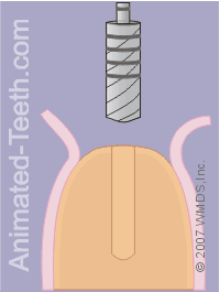 Animation showing enlarging the hole for the tooth implant.