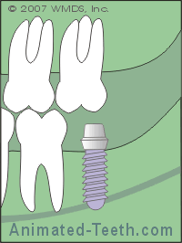 Animation showing that a dental implant cannot be placed in the area of the mandibular nerve.