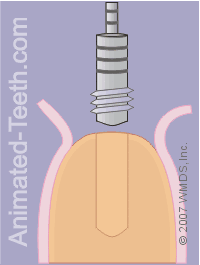 Animation showing using a tap to create screw threads for the tooth implant.