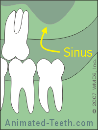Animation showing how a sinus lift increases the amount of bone for the implant.