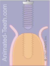 Animation showing the insertion of the implant in its prepared hole.
