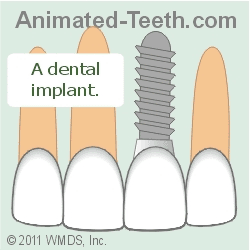 Animation comparing root canal treatment and dental implant placement.