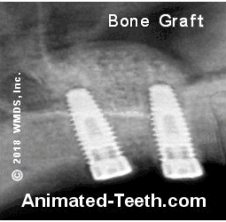 Animation showing how the extent of a sinus bone graft appears on an x-ray.