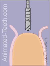 Animation showing creating the initial portion of the dental implant pilot hole.