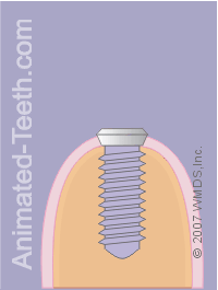 Animation showing component parts of an implant.
