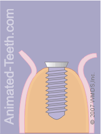 Animation showing placing the implant cap and repositioning the gum tissue around it.