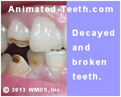 Picture of teeth with extensive tooth decay.
