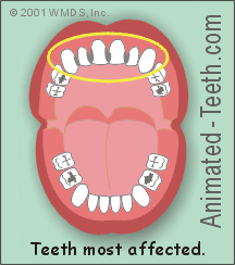 Animation illustrating the tooth decay pattern usually displayed with baby-bottle caries syndrome.