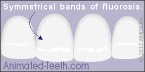 Illustration of teeth that have bands of fluorosis staining.