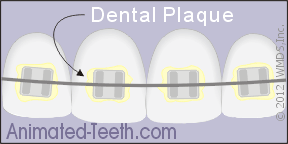 Animation illustrating white spot lesions that have formed around braces due to dental plaque accumulate.