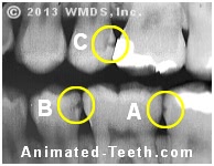 A bite-wing x-ray showing examples of cavities on 2 teeth.