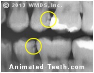 Bitewing x-ray of teeth with cavities.