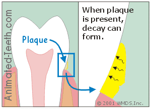Animation illustrating demineralization of tooth enamel by acids from dental plaque.