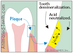 Animation illustrating acid attack (cavity formation) on tooth enamel.