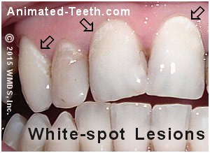Picture of white-spot lesions on teeth.