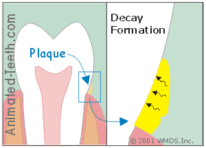 Animation illustrating the remineralization of damaged tooth enamel.