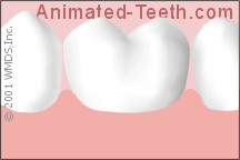Animation illustrating how gum recession places a tooth's root at risk for cavities.