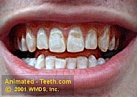 Picture of teeth that have severe brown fluorosis staining.