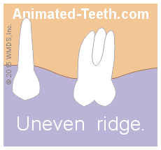 Animation illustrating alveoloplasty after molar tooth extraction.