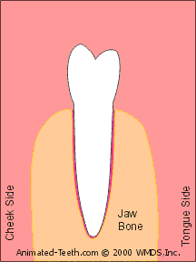 Animation showing how rocking a tooth back and forth enlarges its socket.
