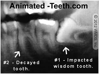 X-ray of two teeth, one of which will require a 'surgical' extraction, the other a 'simple' one.