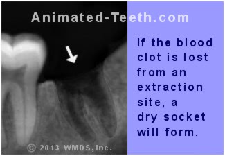 Graphic explaining if an extraction site's blood clot is lost, a dry socket will form.