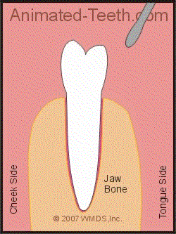 Animation illustrating how using a dental elevator can extract a tooth.