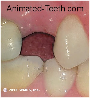 Picture of healed extraction site showing alveolar ridge resorption.